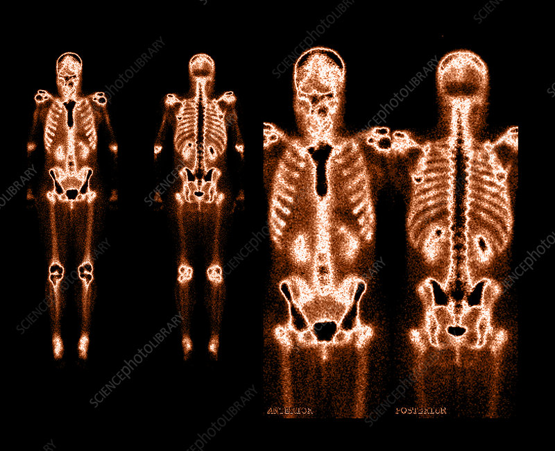 Bone Scan (Whole Body / 3-Phase)