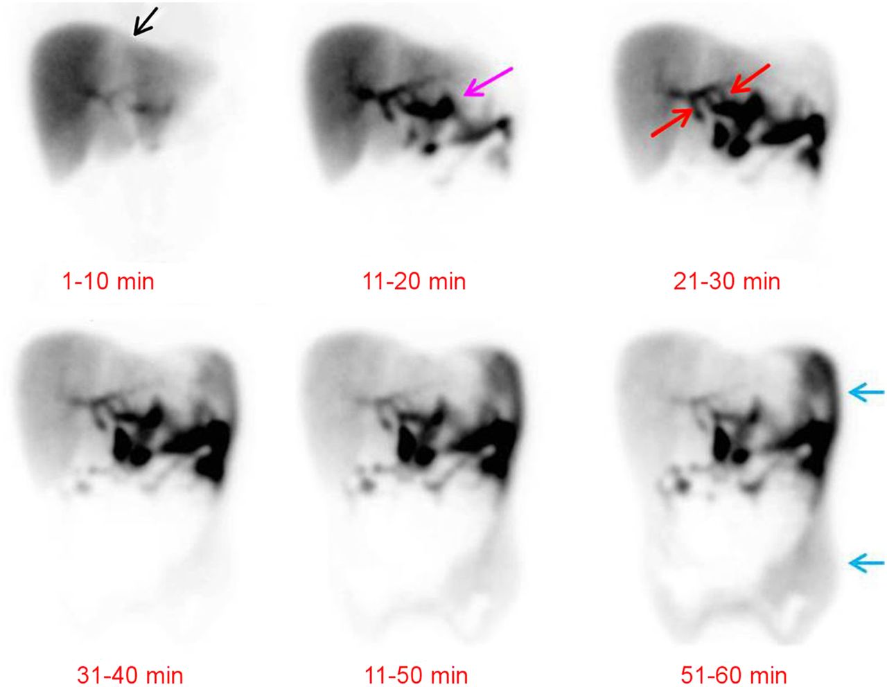 HIDA Scan (Hepatobiliary)