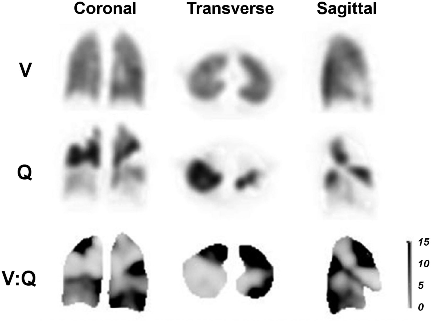 Lung Perfusion Scan (V/Q Scan)